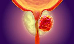 Ağrı ve kırıklara dikkat, prostat kanseri kemiklere yayılabilir